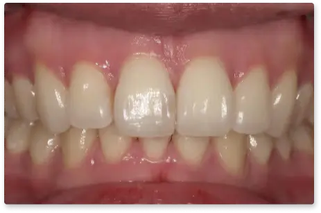 出っ歯 After
