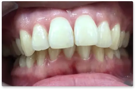 出っ歯 Before
