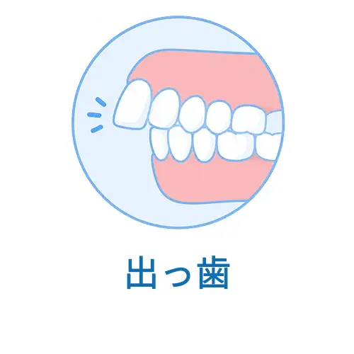 出っ歯