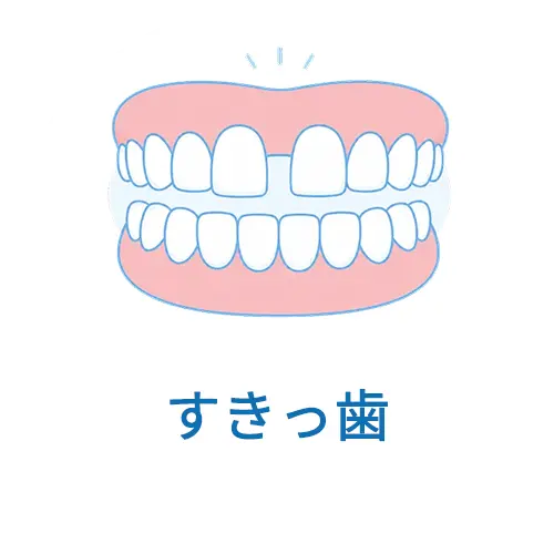 すきっ歯