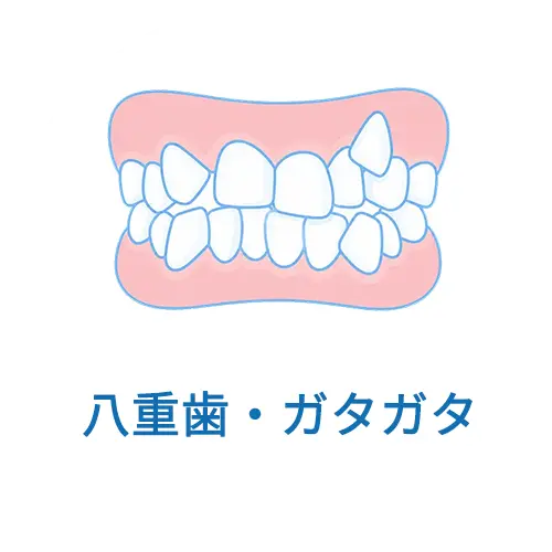 八重歯・ガタガタ